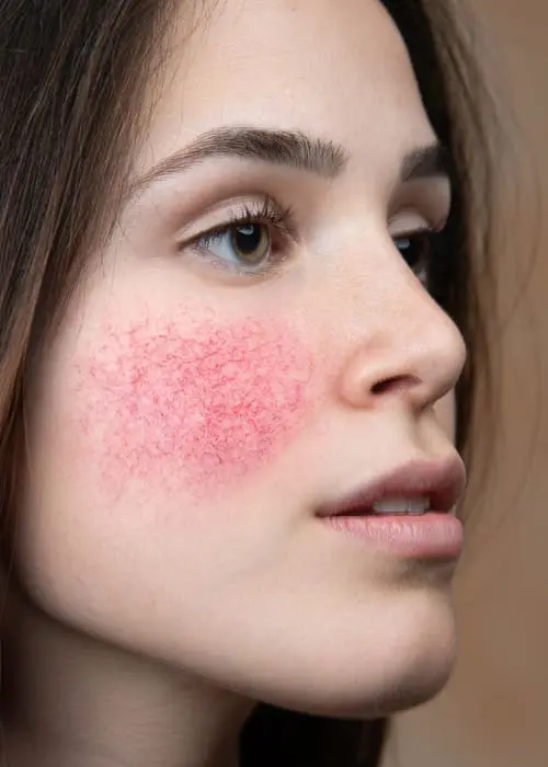 Skinboss - Rosacea